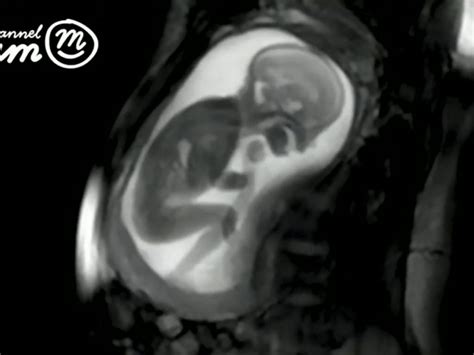 Breathtaking New Mri Scan Of Unborn Babies In The Womb Show Smiling