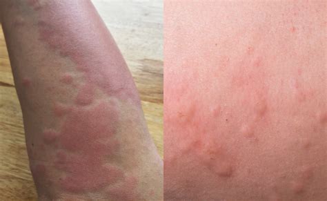 Hives Causes Symptoms And Management