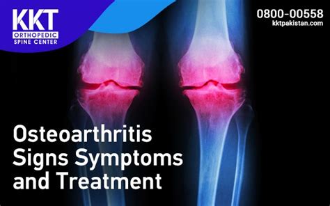 Osteoarthritis Signs Symptoms And Treatment Testingform