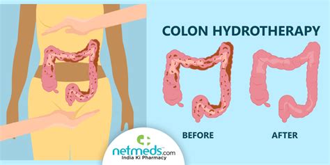colonic irrigation what is it will it eliminate body toxins procedure benefits and risks of