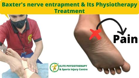 Baxters Nerve Entrapment Heel Pain Andt Its Physiotherapy Treatment