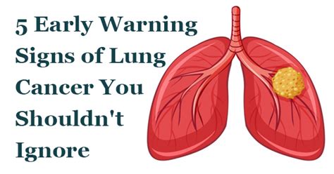 5 Early Warning Signs Of Lung Cancer You Shouldnt Ignore Affordable