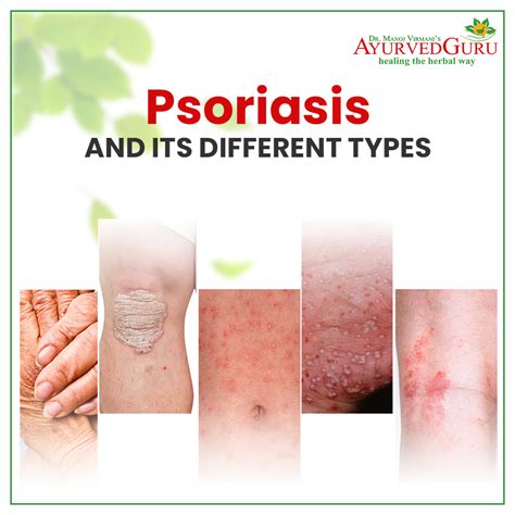 Psoriasis And Its Different Types Ayurved Guru