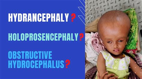 Clinical Picture Hydrancephaly Holoprosencephaly Obstructive
