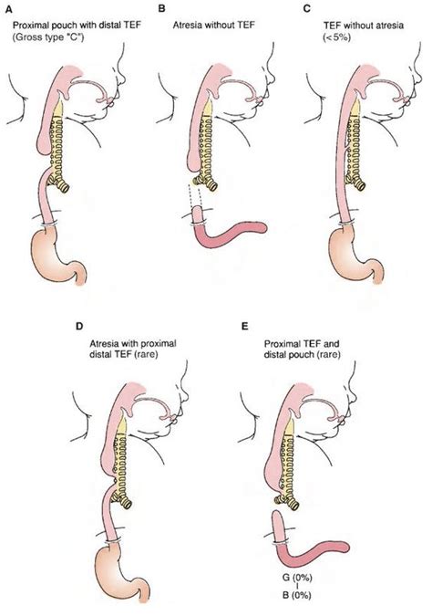Esophageal Atresia And Tracheoesophageal Fistula Tef A Proximal