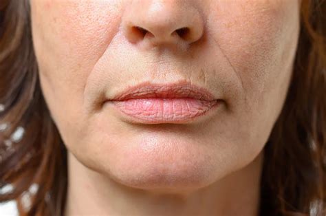 Botox For Upper Lip Cosmetic Surgery Tips