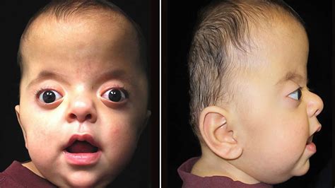 Apert Syndrome Causes Symptoms Diagnosis And Apert Syndrome Treatment