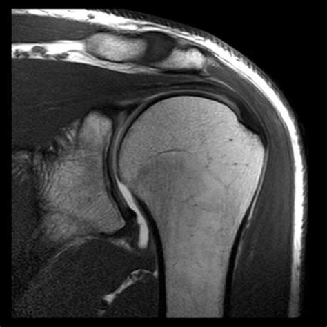 Normal Shoulder Mri Philip Waldman Do Fscco