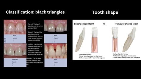 Black Triangles Who Did It Orthodontics In Summary