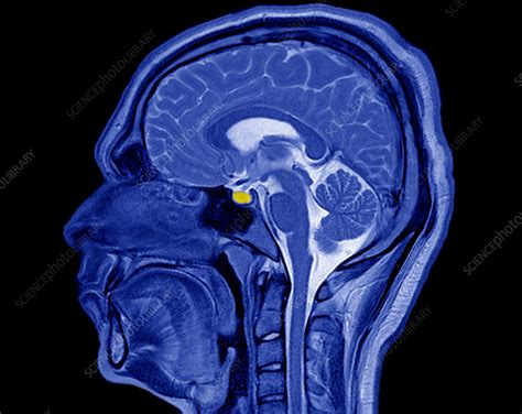 Head Brain And Pituitary Gland Mri Scan Stock Image C0373115
