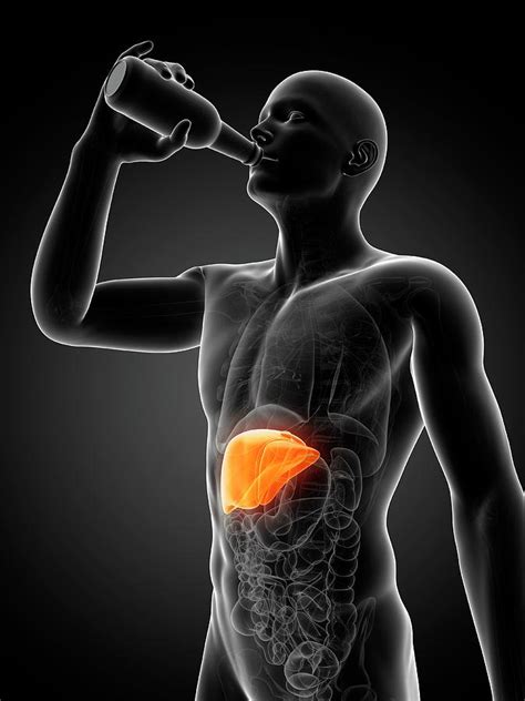 Alcoholic Liver Disease Photograph By Scieproscience Photo Library