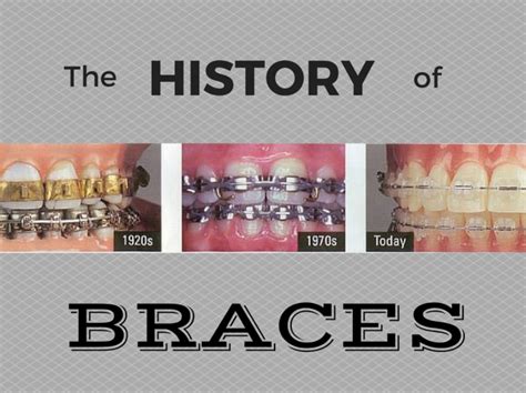 The History Of Braces Dr Chauvin Lafayette Dentist
