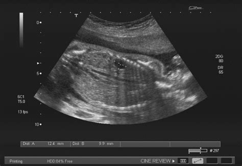 Fetal Splenic Cyst Antenatal Diagnosis And Outcome Bmj Case Reports