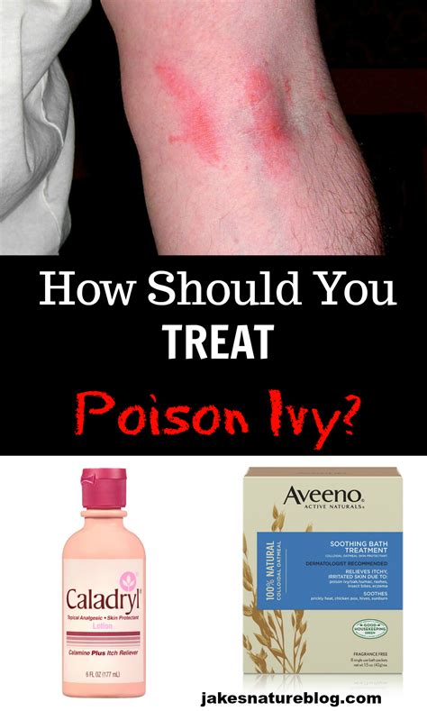 Poison Ivy Treatment What Should You Do Jakes Nature Blog