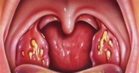 Squamous Cell Carcinoma Throat Survival Rate Canceroz