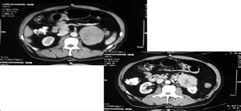 Isolated Unilateral Adrenal Metastasis As A Presenting Featu Saudi