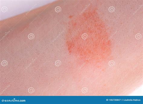 The Great Red Spot On The Skin Closeup Stock Image Image Of Medicine