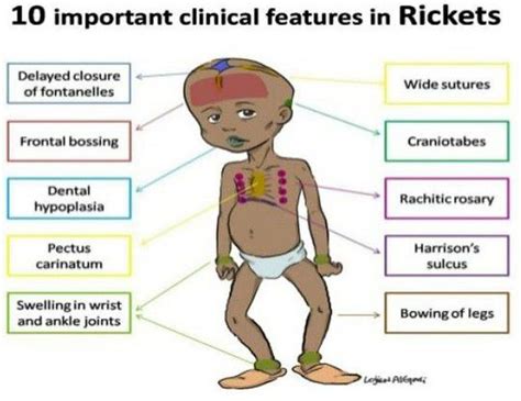 Rickets Signs Medizzy