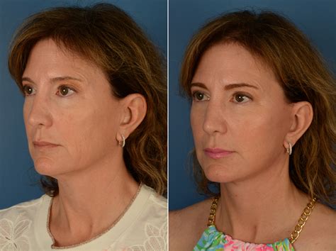 The Uplift Lower Face And Neck Lift Photos Naples Fl Patient 14515
