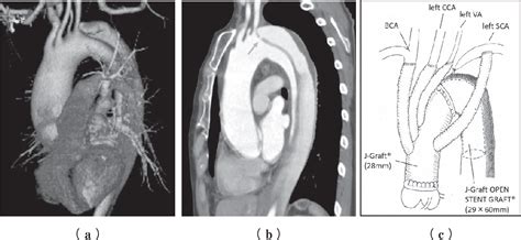 Figure 1 From A Case Of Completely Thoracoscopic Surgery For
