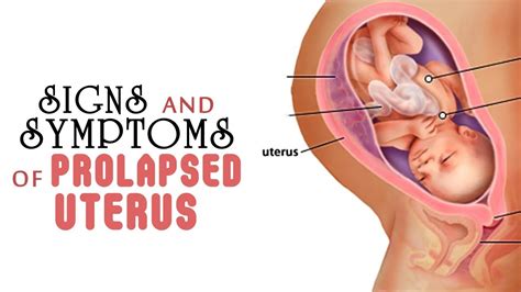 6 Signs And Symptoms Of Prolapsed Uterus Youtube