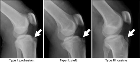 Figure 1 From The Significance Of Bone Scan And Classificationin Young
