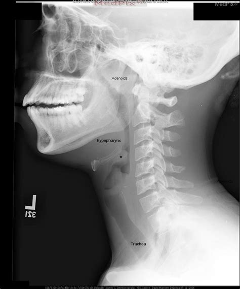 Normal Epiglottis X Ray