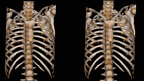 Ct Scan Thoracic Spine 3d And X Ray Thoracic Spine Finding The Film