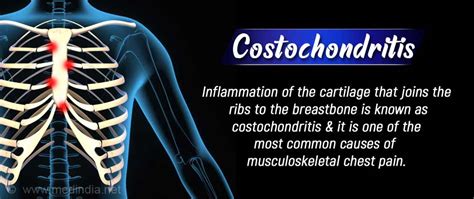 Costochondritis Tietzes Syndrome Causes Symptoms Signs