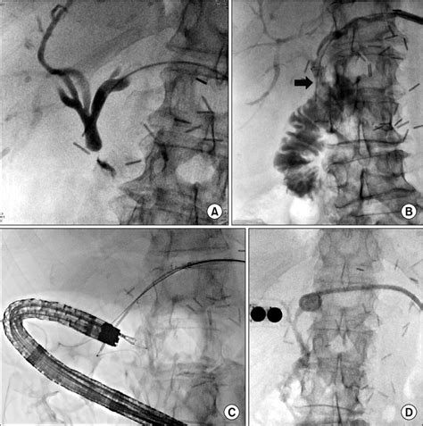 A Cholangiogram Demonstrates A Biliary Stricture At The Download