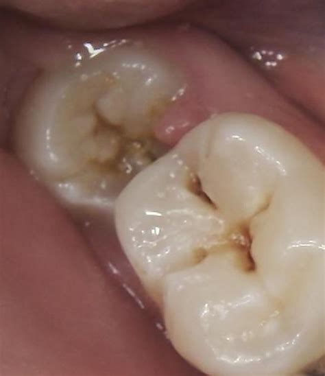 Wisdom Teeth Why Are They A Problem And What Can Be Done About Them