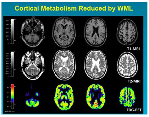 Neuroimaging In Cerebral Small Vessel Disease