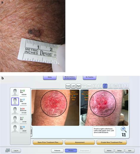 A Clinical Image Of Melanoma In Situ On The Left Forearm B Dashboard