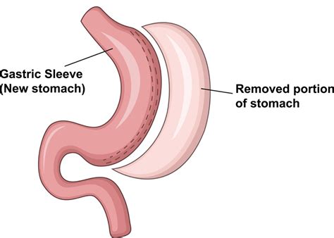 Choosing The Right Gastric Sleeve Surgeon Key Factors To Consider Atoallinks