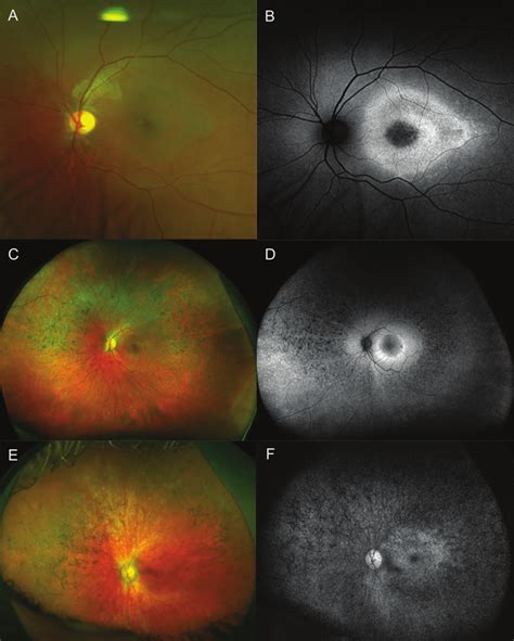 Fundus Imaging Of The Left Eye Only Of Inherited Retinal Dystrophy