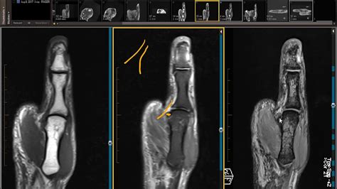 Case Review Young Patient With Thumb Injury On Mri Youtube