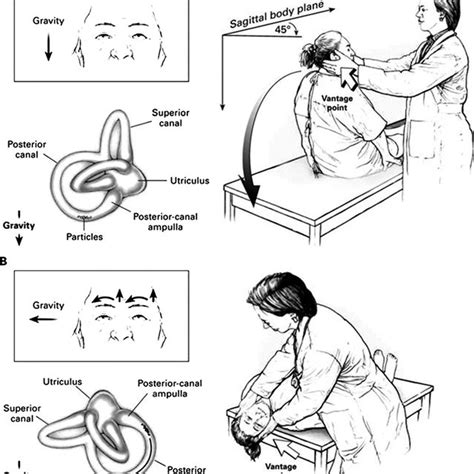 The Semont Maneuver For Right Sided Bppv Patient Is Seated In The Download Scientific