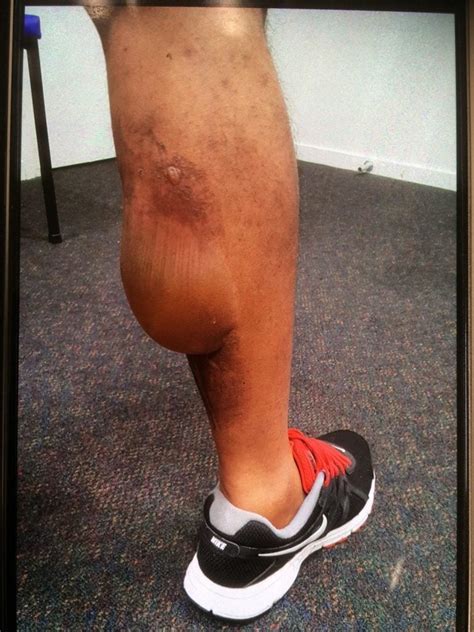 Post Sports Injury Burn Due To Inappropriate Use Of Cryotherapy