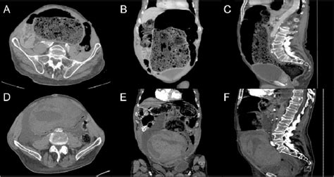 Ct Abdomen And Pelvis With Intravenous Contrast Admission Imaging