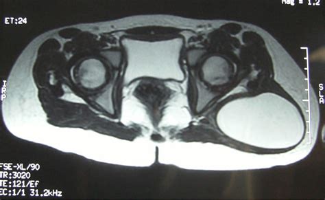 Primary Hydatid Cyst As A Cause Of Pseudotumor Of The Buttock