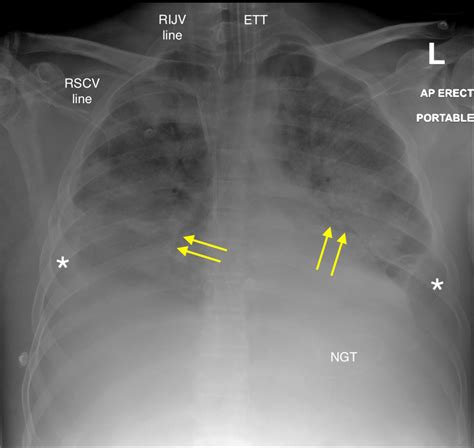 Acute Respiratory Distress Syndrome Ards Chest X Ray Radiology At My