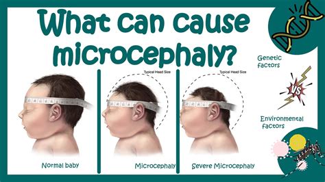 Microcephaly What Is The Main Cause Of Microcephaly What Is Life