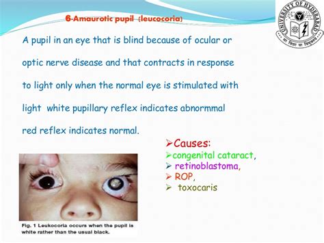 Pupil Anomalies And Disorders Shiva Ppt