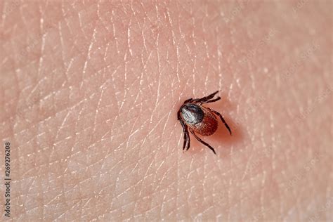 Sucking Tick Macro Photo On Human Skin Ixodes Ricinus Bloated