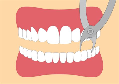 Das entscheidet der zahnarzt oder der kieferchirurg wenn der zahn gezogen wurde, nähen ist nicht immer nötig. Zahn ziehen | Alles was Sie wissen müssen | 360°zahn