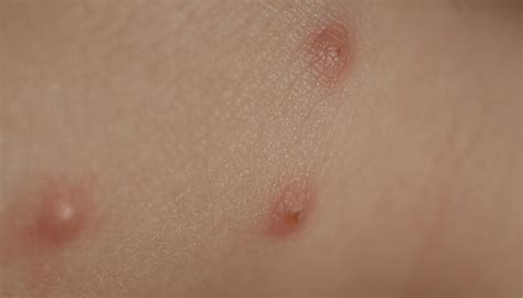 Do Bed Bug Bites Leave Pimples Whatodi