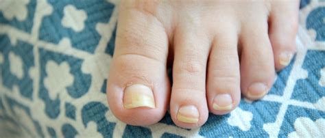 See more ideas about toenail fungus remedies, toenail fungus, nail fungus. Don't Bury Your Toes in the Sand This Summer: Tips to ...
