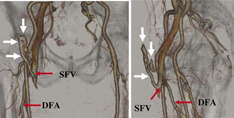 An Unusual Femoral Arteriovenous Fistula Following Cardiac