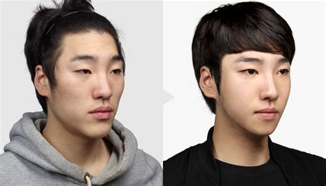 Celebrity Male Plastic Surgery Before And After Photos 016