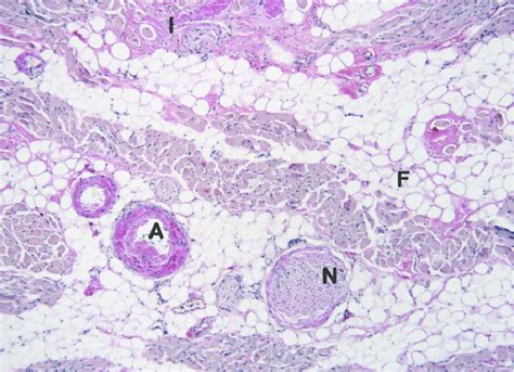 Amyloid Involvement Of The Tongue Presence Of Amyloid In The A